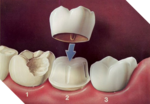 Dental Crown Stevenage